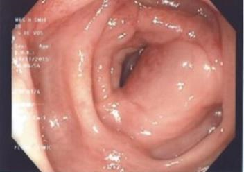 Before treatment